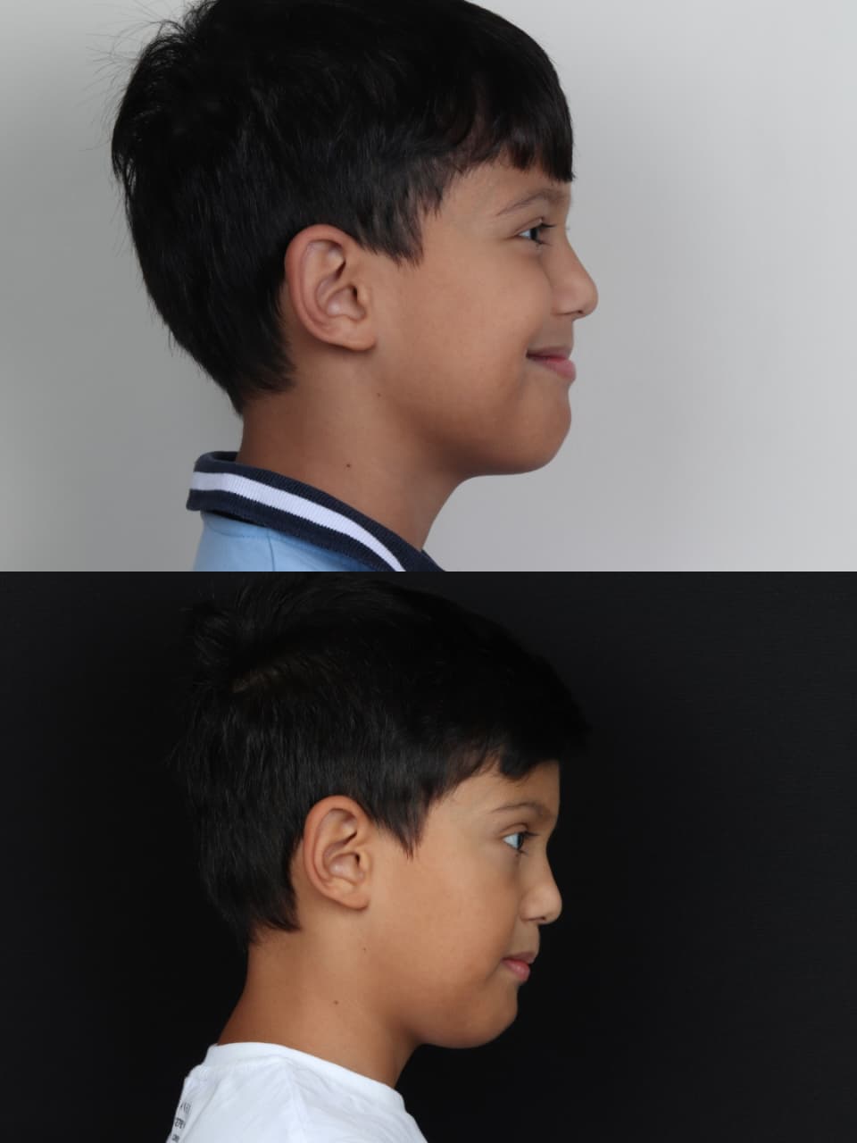 תוצאה לפני ואחרי טיפול שיניים