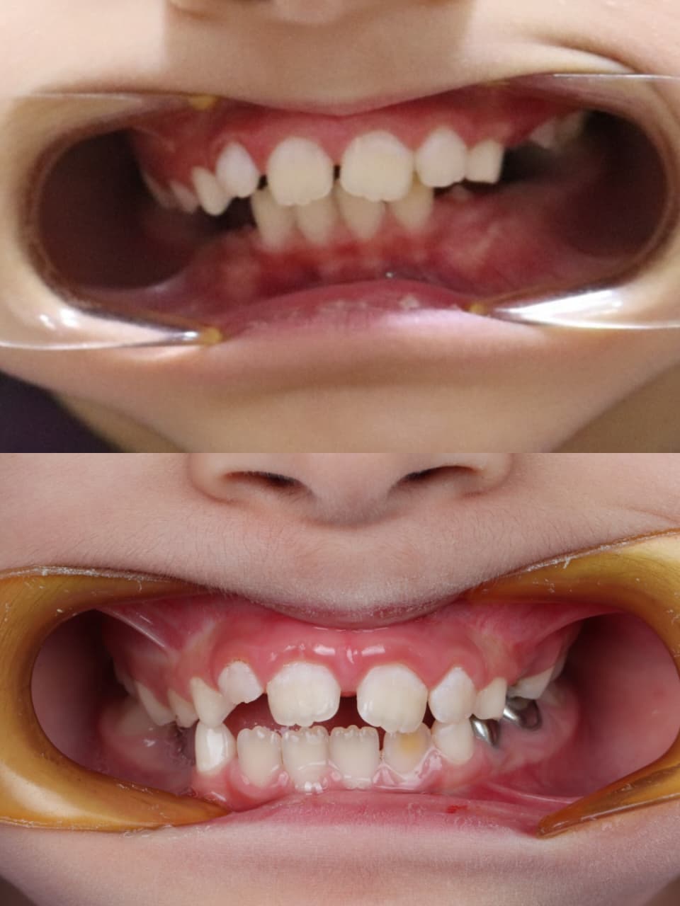 תוצאה לפני ואחרי טיפול אורתודונטי