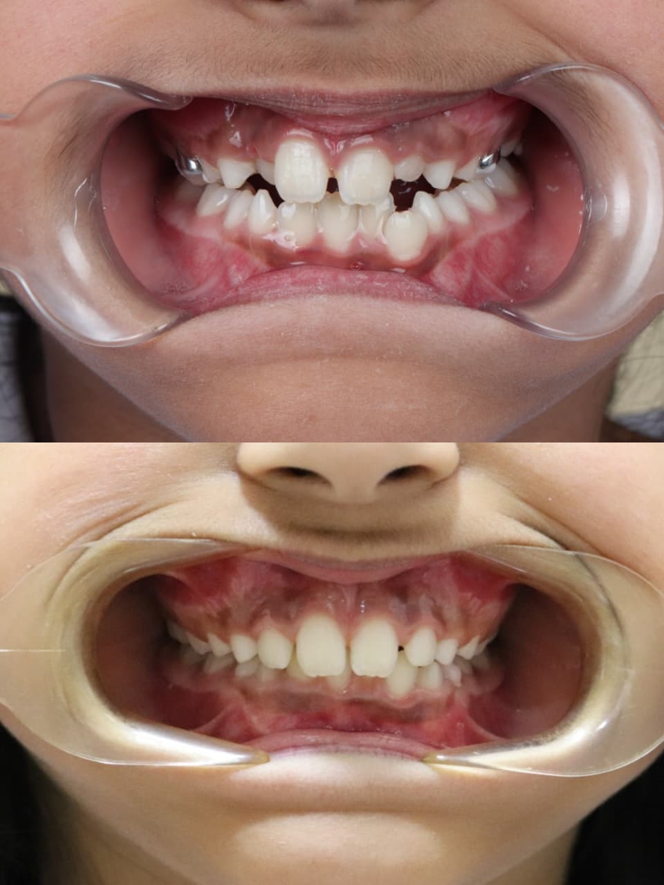 תוצאה נוספת לפני ואחרי